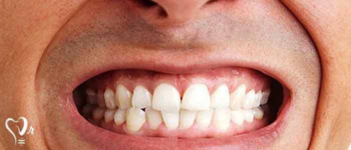 کاشت ایمپلنت دندان در افرادی که دندان قروچه دارند